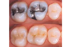 Tooth Filling Treatments