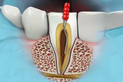Endodontics Treatments