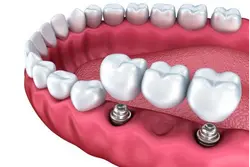 Dental Implants Treatments