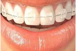 Orthodontics Treatments