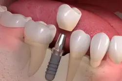 Dental Implants Treatments