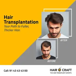 Hair Transplant