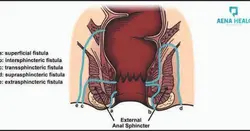 Treatment for Fistula