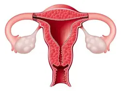 Endometriosis