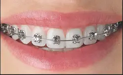Orthodontic treatments