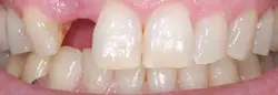 Missing Tooth Replacement