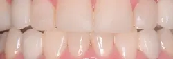 Incorrect Bites/Teeth Grinding/Bruxism treatments