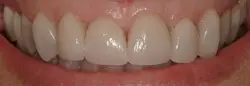 Gummy Smiles treatments