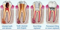 RCT(Root Canal Treatment)