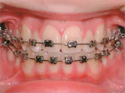 Orthodontic treatments