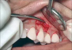 Flap surgeries