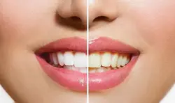 Teeth whitening
