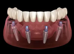 Dental implants