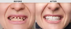 Missing Tooth/Teeth loss Treatment