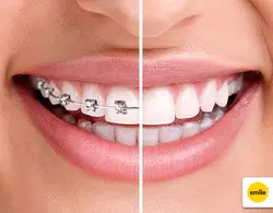 Tooth correction