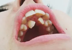 Disorder of teeth
