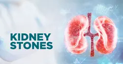 Kidney Stones
