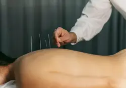 Acupuncture Treatment