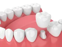 Crown Treatment