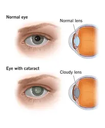 Cataract Surgery