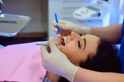 Teeth Whitening