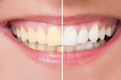 Teeth Whitening