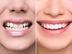 Smile Designing