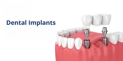 Dental Implants