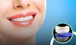 Smile Makeover 