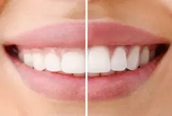 Gum Treatment