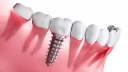 Dental implants