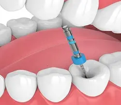 Root Canal 