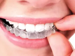  Invisalign
