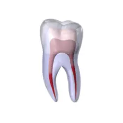 Root canal Treatment