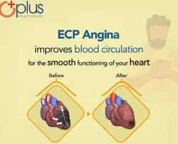 Angina Treatment