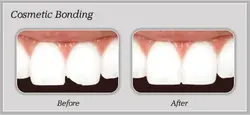 Cosmetic Bonding