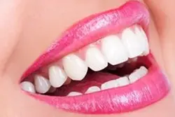 Teeth Whitening