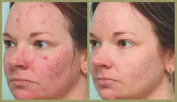 Sun Tan Removal