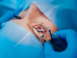 Lasik Treatment