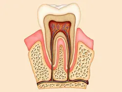 Root Canal Therapy